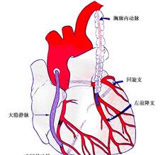 心肌梗死治疗