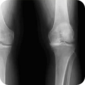膝蓋手術