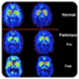 帕金森病的症状 Parkinson...