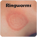 癣 RINGWORMS