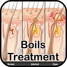 Boils Symptoms Treatment