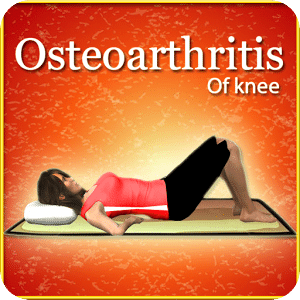 Osteoarthritis of knee