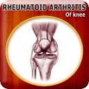 Rheumatoid Arthritis of Knee