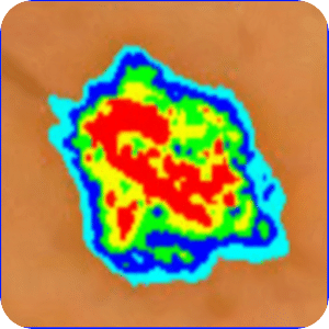 Skin Mole Analysis