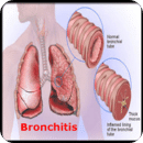 Bronchitis Guide
