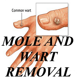 Mole and Wart Removal