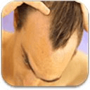 Hair Loss Treatment &amp; Remedies