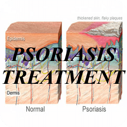 Psoriasis Treatment!