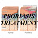 Psoriasis Treatment!