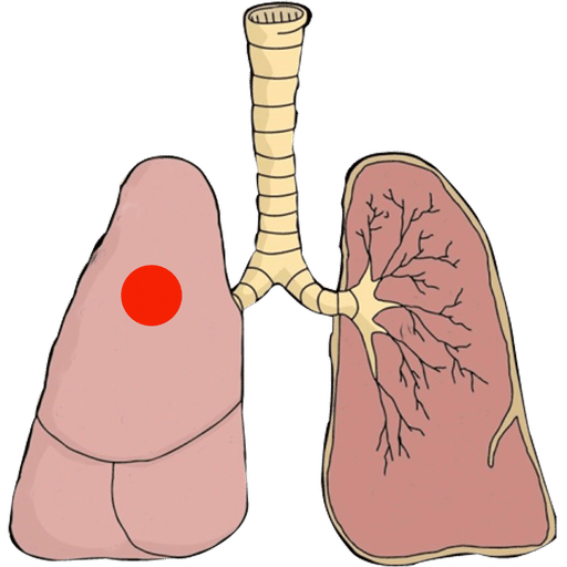 Lung